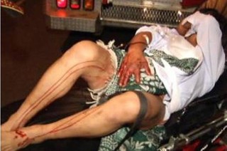 Sốc với thanh niên Hải Phòng tự tay cắt nát 'của quý'