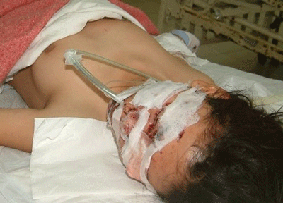 Quảng Nam: Nổ bình khí hydro bơm bóng bay, 4 người bị thương 1