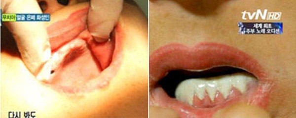 Hàn Quốc: Rụng sạch răng vì phẫu thuật thẩm mỹ 3