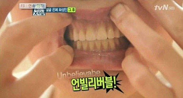 Hàn Quốc: Rụng sạch răng vì phẫu thuật thẩm mỹ 10