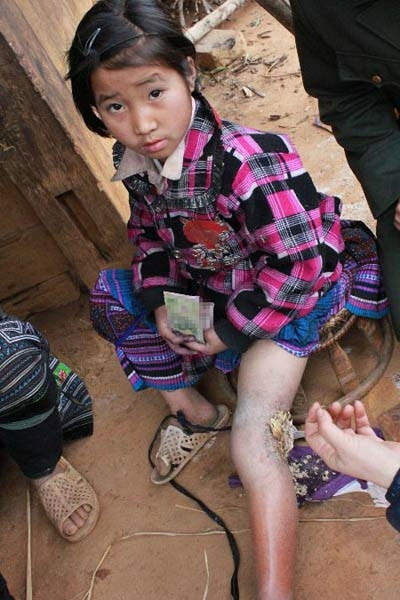 Bé gái 3 năm sống với cái chân lúc nhúc giòi Be-gai-3-nam-song-voi-cai-chan-luc-nhuc-gioi