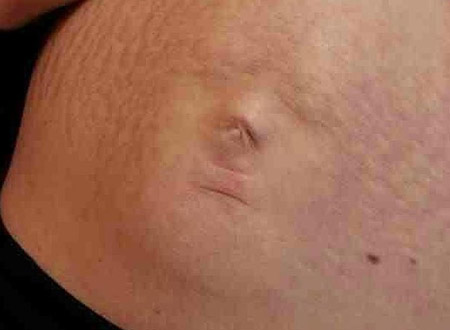 Ngạc nhiên bụng bầu có hình mặt em bé 1