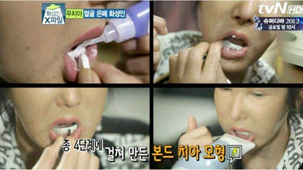 Hàn Quốc: Rụng sạch răng vì phẫu thuật thẩm mỹ 2
